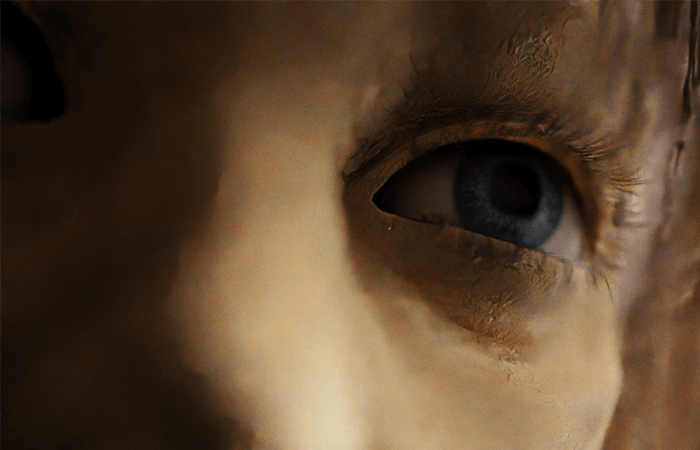 Dali Syndrome